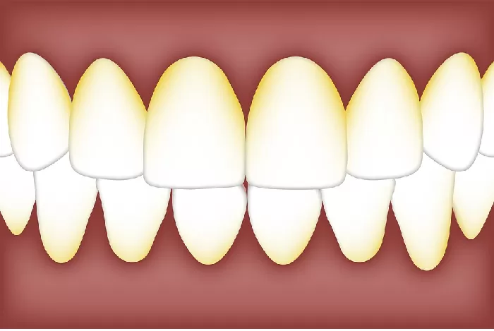 Cara Alami yang Bisa Kamu Lakukan Untuk Menghilangkan Karang Gigi